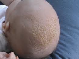 Treatment For Dandruff In Babies