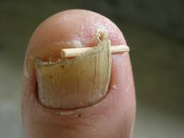 Lift Nail Digging Into Skin