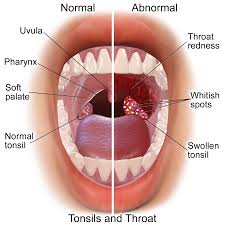 Swollen Tonsils