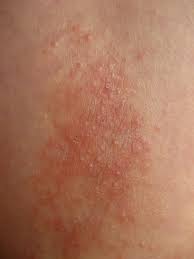 Chronic Skin Conditions