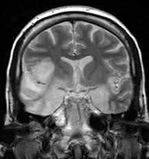 Herpetic Encephalitis
