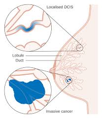 Ductal Carcinoma In Situ