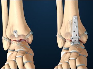 Ankle Fusion