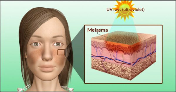 Causes Of Melasma