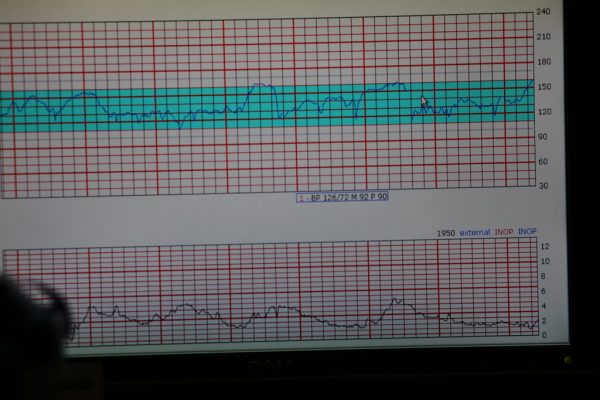 Fetal Heartbeat Monitoring