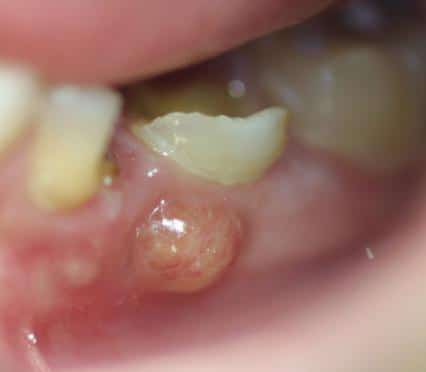 Tooth Abscess