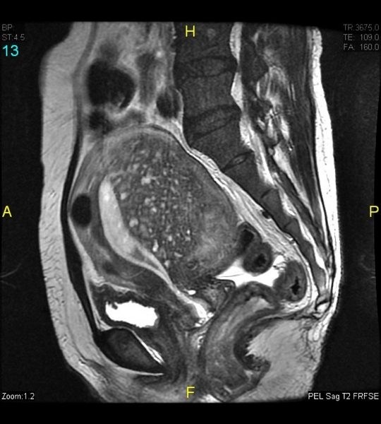 Adenomyosis