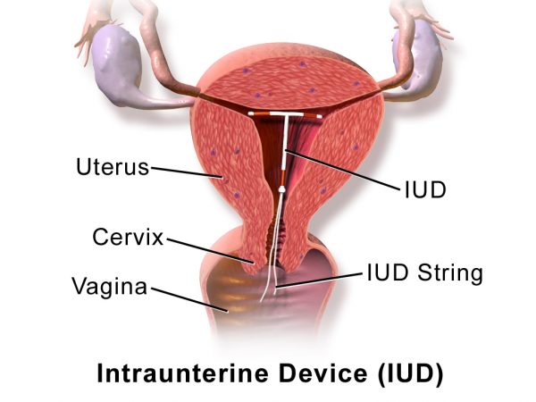 Intrauterine Device (IUD)