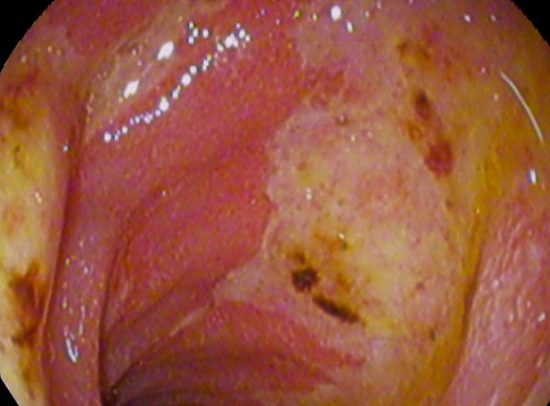 Duodenal Ulcers