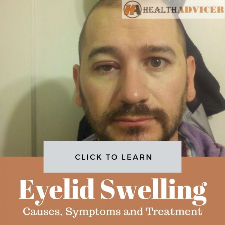 Eyelid Swelling