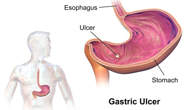 Gastric Ulcers