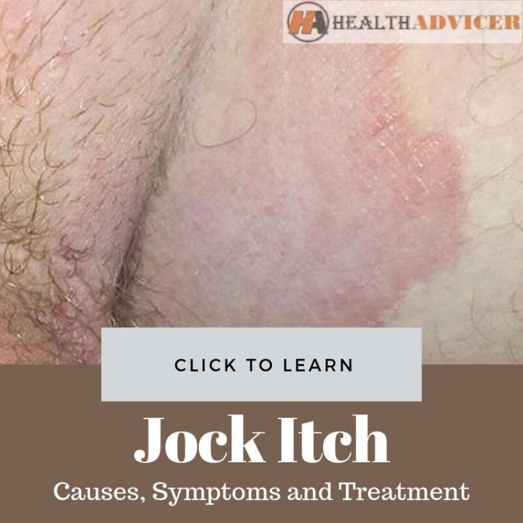 Jock Itch Causes Treatment