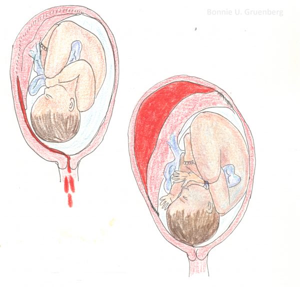 Symptoms Of Placental Abruption