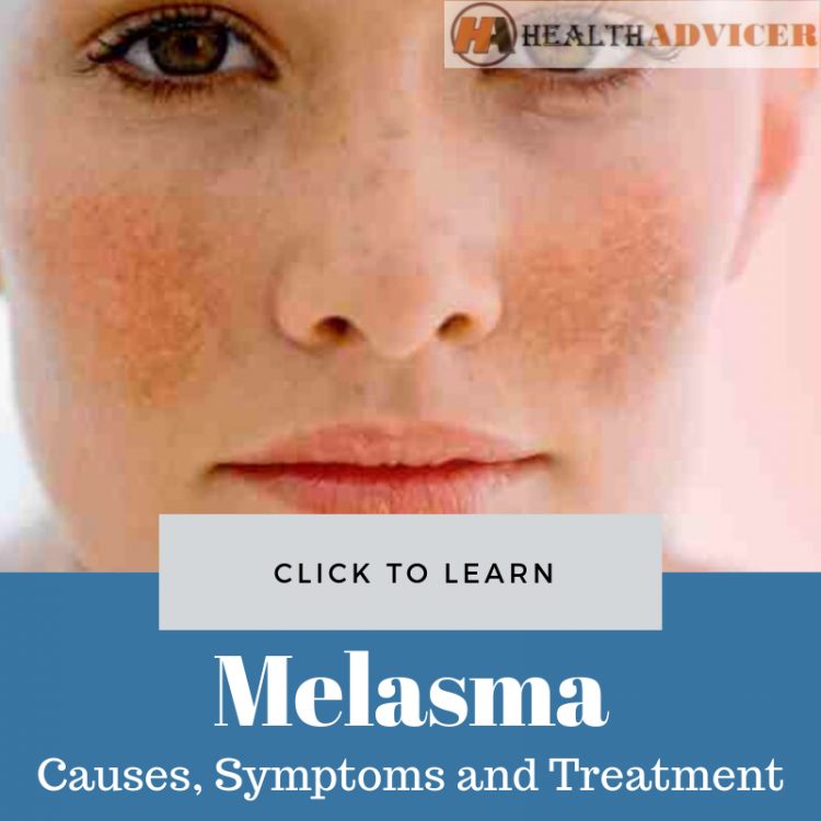 Melasma Causes Treatment