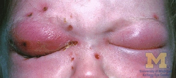 Orbital Cellulitis