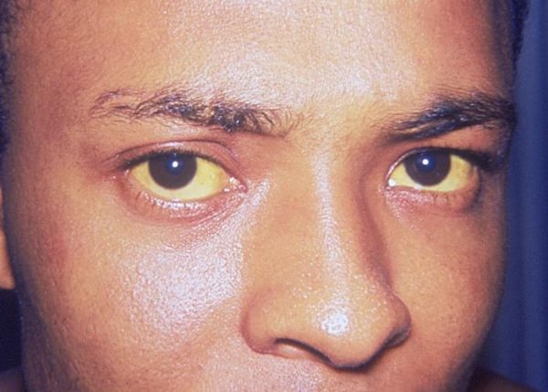 Jaundice In Adults