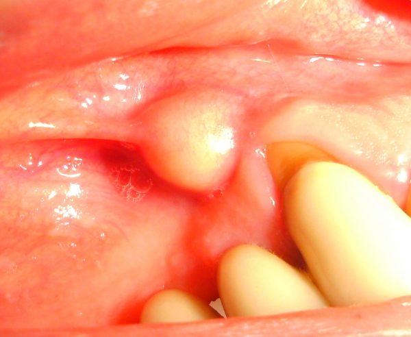 Periapical abscess