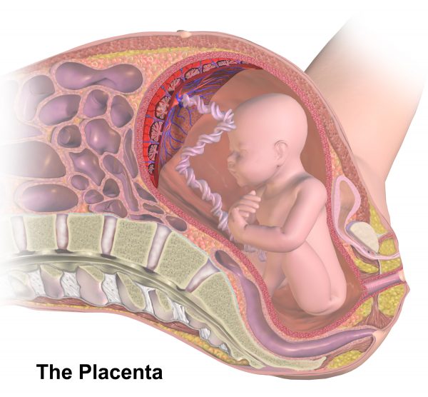 Placental Abruption