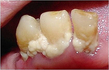 Tooth Abscess