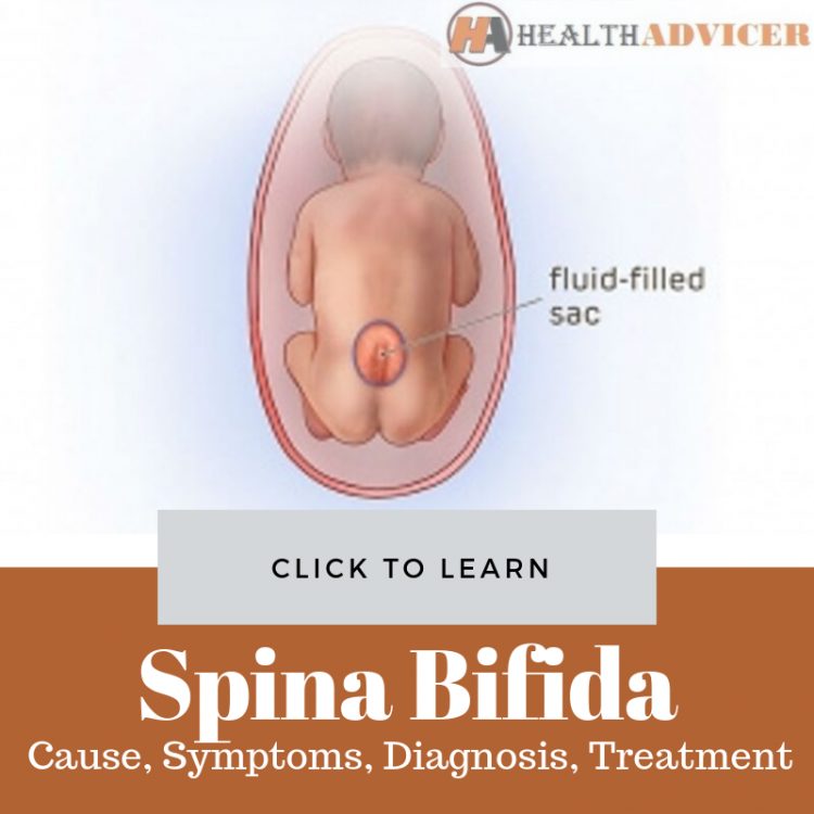 Spina Bifida