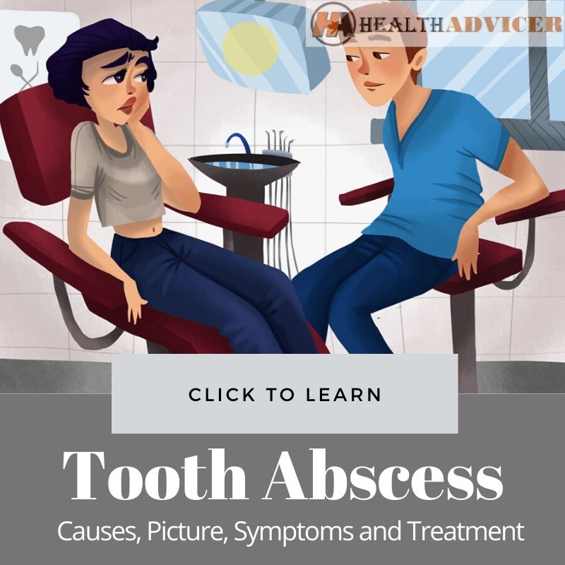 Tooth Abscess Causes picture treatment