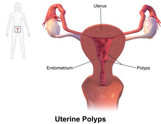 Polyps