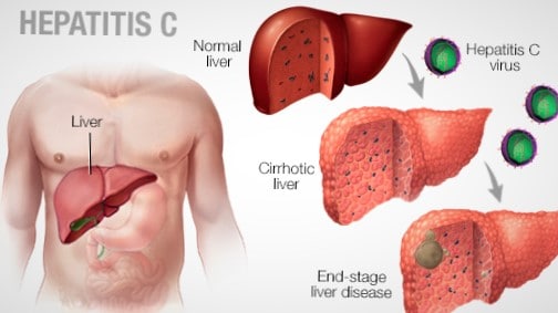 Hepatitis C