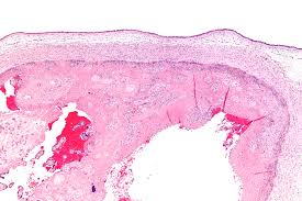 Chorioamnionitis