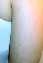 Pimples on arms