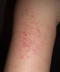 Keratosis Pilaris