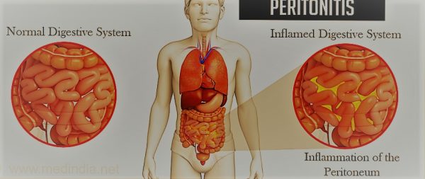 Complications Due To Peptic Ulcer