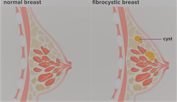 Fibrocystic Breasts