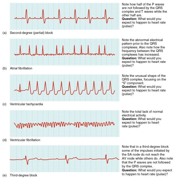 Heart Problems