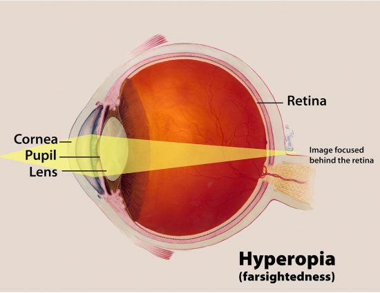 Hyperopia