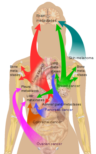 Cancer In Other Parts