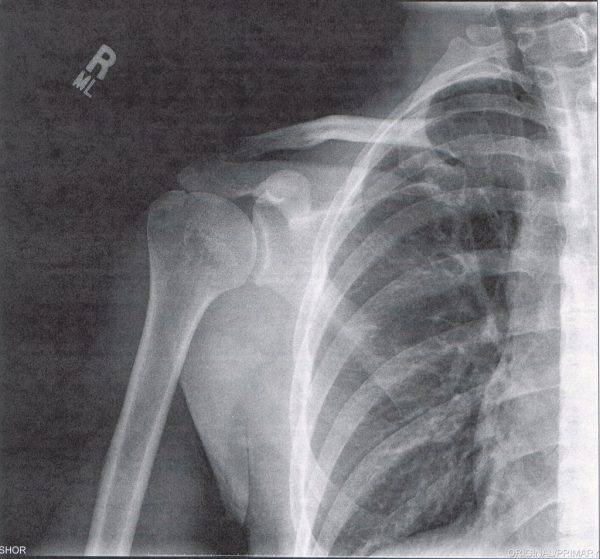 Broken Shoulder