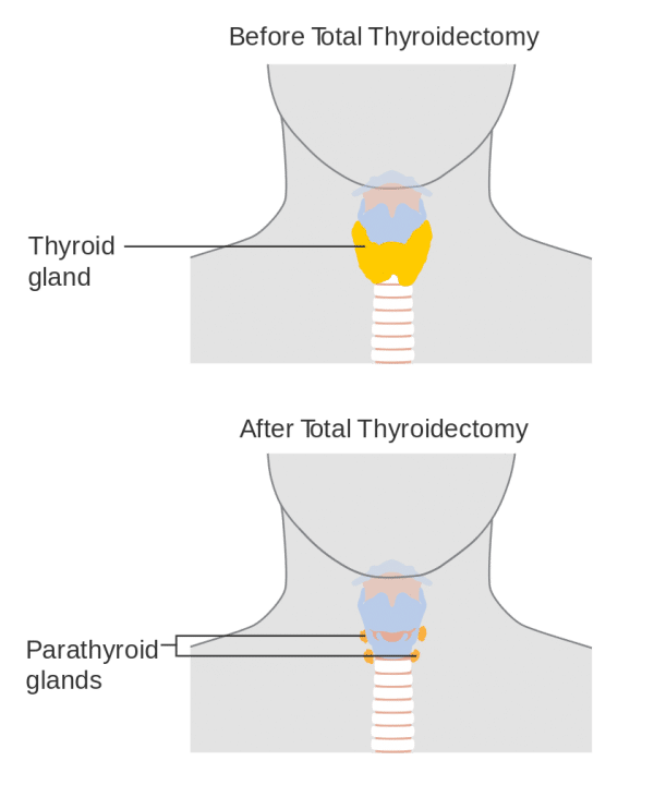 Total Thyroidectomy