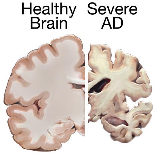 Symptoms Of Alzheimer’s disease