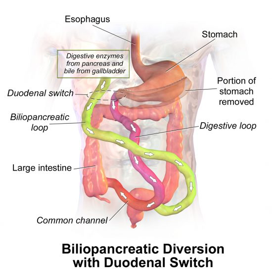 Biliopancreatic