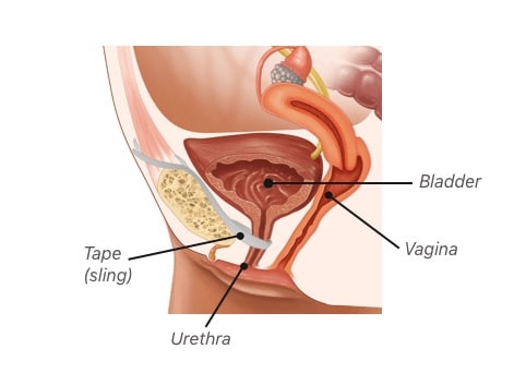 Traditional Sling Surgery