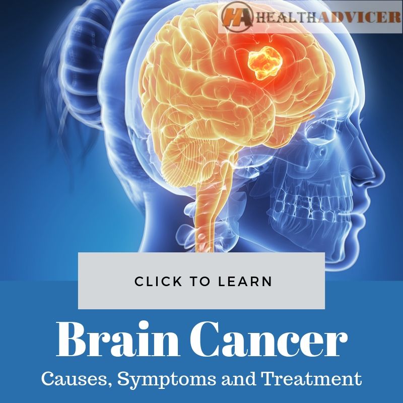 Brain Cancer Causes, Picture, Symptoms and Treatment