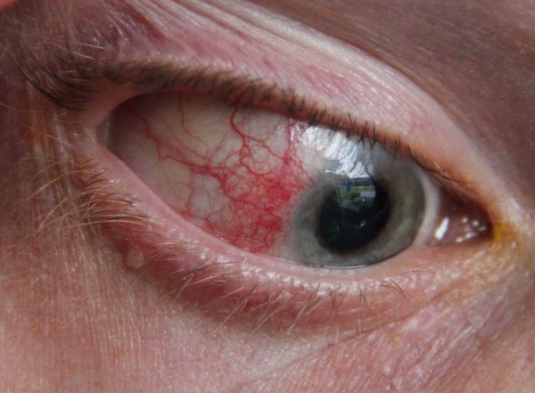 Episcleritis