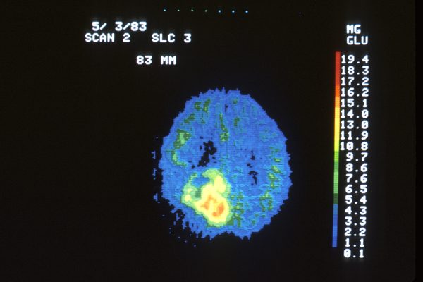 Diagnosing Brain Cancer