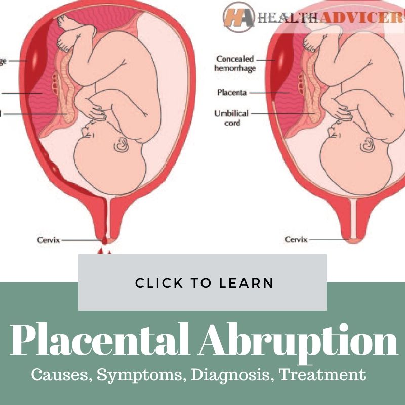 Placental Abruption