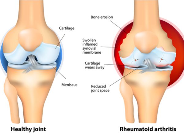 Rheumatoid Arthritis