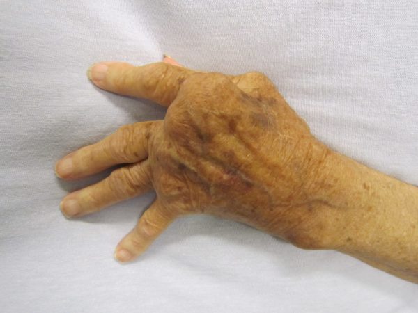 Know About Arthritis