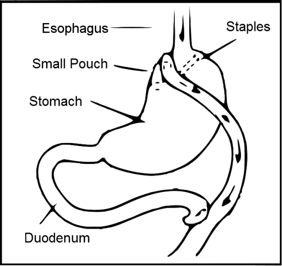 Roux-En-Y Gastric Bypass