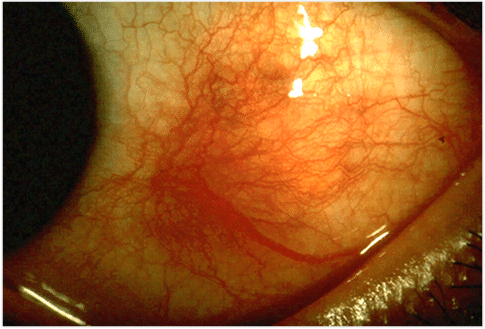 Symptoms Of Scleritis