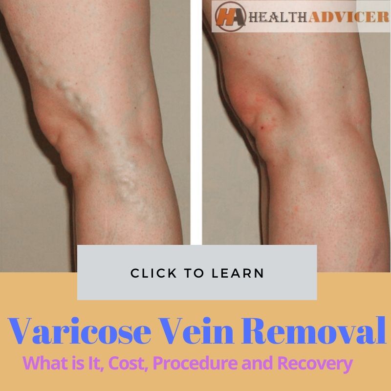 Varicose Vein Removal