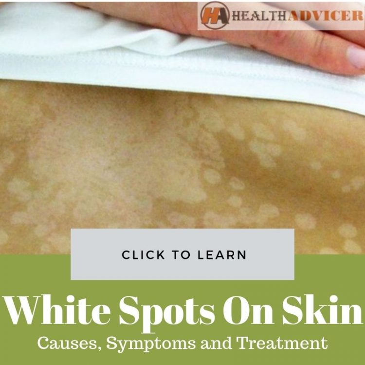 White Spots On Skin Causes Treatment